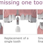 1-dental-implants-brooklyn-ny