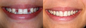 Melbourne-dental-implants- (1)