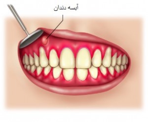 علت آبسه دندان و راه درمان آن