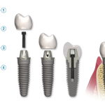 dental-implant-breakdown