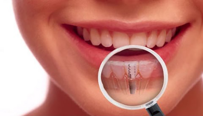 implant (1)
