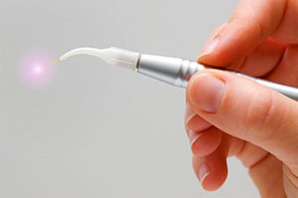 کاربرد لیزر دندانپزشکی