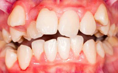 نامرتبی دندان‌ها