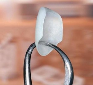 porcelain veneer
