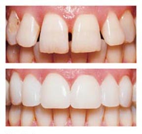 veneers