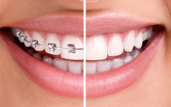 آیا می‌توان از بریس یا سیم‌کشی ارتودنسی به‌جای ایمپلنت دندان استفاده کرد