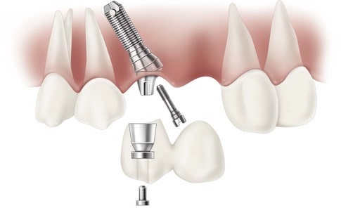 ایمپلنت دندان بهداشت دندان
