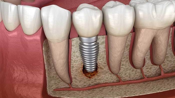 سؤالات رایج درباره ایمپلنت