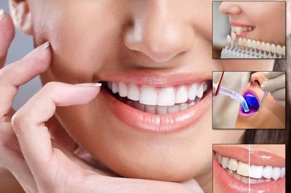 ونیرهای دندانی از روش‌های دندانپزشکی زیبایی در اصفهان