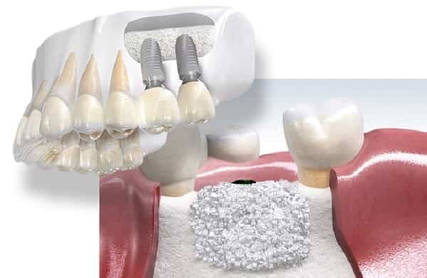 پیوند استخوان برای ایمپلنت دندان چگونه انجام میشود؟